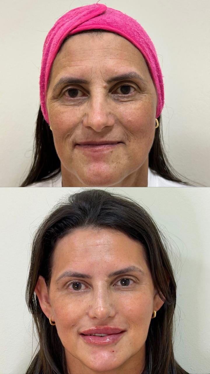 Comparativo frontal do rosto: antes na parte superior e depois na inferior.