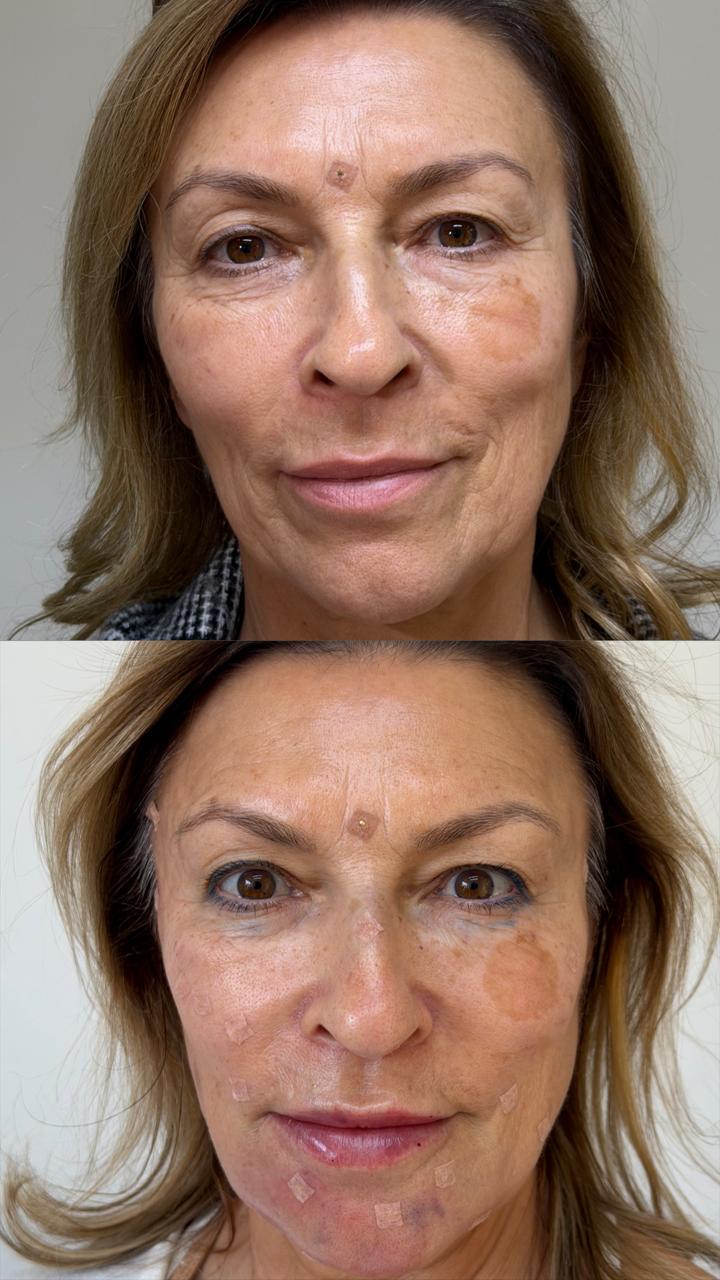 Comparativo frontal do rosto em dois momentos: antes na parte superior e depois na inferior.