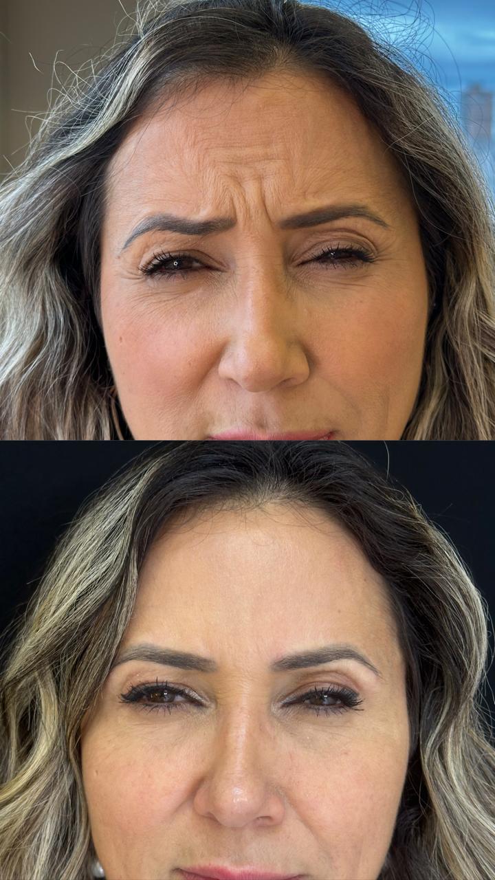 Comparativo da região superior do rosto: antes na parte superior e depois na inferior.